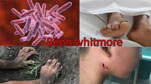 Bệnh Whitmore triệu chứng nguyên nhân, điều trị và cách phòng tránh
